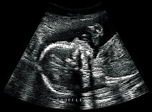 ultrasound